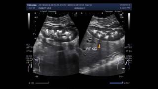 Ultrasound Video showing bilateral Medullary nephrocalcinosis and renal calculi [upl. by Goldsworthy874]