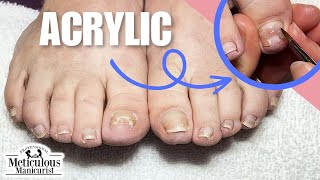 Big Toenail Repair Pedicure Tutorial at Home [upl. by Attelliw]