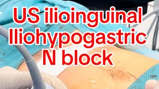 US guided Ilioinguinal iliohypogastric ns block [upl. by Llyrehc580]