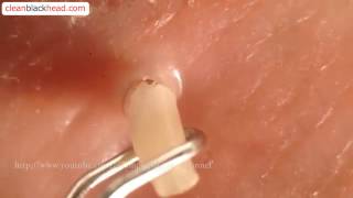 Blackhead Removal Tool  Popping Whiteheads and Blackheads Close Up [upl. by Skoorb497]