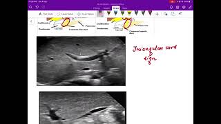 Biliary atresia radiology [upl. by Atikat]