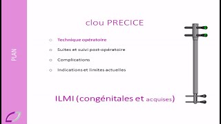 allongement osseux par clou PRECICE principes et indications [upl. by Hacceber169]