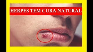 Herpes Tem Cura Natural Em Poucos Dias [upl. by Walter]