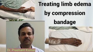 Treating limb edema by compression bandage [upl. by Noryd]