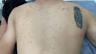 ACNE TREATMENT VU QUYNH MI Acne On Boys Back 2024 [upl. by Gimble]