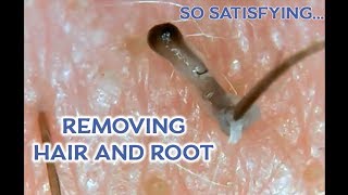 Squishys 2 Ingrown Hair Root Removal Microscopic [upl. by Yrailih330]