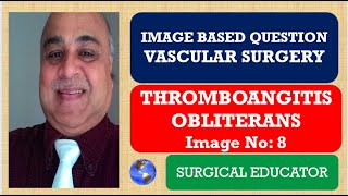 THROMBOANGITIS OBLITERANS  VASCULAR SURGERY  Image Based Question [upl. by Eagle]