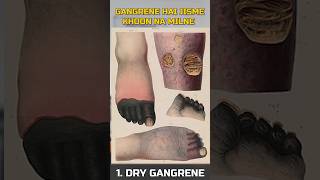 Types of Gangrene  Diabetic Foot  Gangrene  Dr Gaurav Gangwani [upl. by Elvina110]