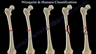 Fractures Of The Femur Shaft Winquist amp Hansen  Everything You Need To Know  Dr Nabil Ebraheim [upl. by Aihsia]