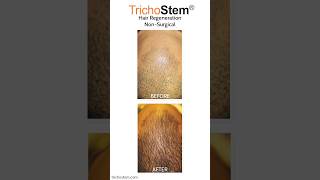 Why TrichoStem Hair Regeneration Patients can Stop Using Minoxidil minoxidil [upl. by Bohlen]