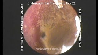 Ear wax removal Golden earwax fungus dry sheet cleaning 20241121 [upl. by Thrift]