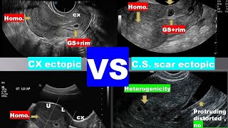 lecture 9 ultrasound of bleeding in early pregnancy 2 [upl. by Eylrac]