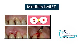 Modified MIST MINIMALLY INVASIVE PERIODONTAL SURGICAL TECHNIQUES DR ANKITA KOTECHA [upl. by Jesselyn502]