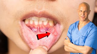 How I Quickly Healed My Canker Sore  Dr Mandell [upl. by Damek]