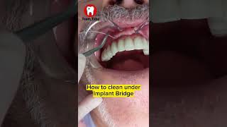 How to floss under Implant Bridge with superfloss flossing dentalcare dentalimplants shorts [upl. by Eatnom]