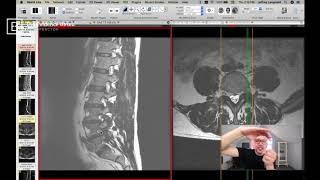 Clinical Series How to See a Pinched Nerve Foraminal Stenosis on MRI [upl. by Anderer]