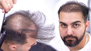 Barbers Magic on a Live Model 👨‍🦲✂️ I Transforming Thinning Hair [upl. by Portia]