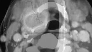 SACCULAR CYSTLARYNGOCELELARYNGEAL CYST DIFFERENCE [upl. by Ecinert]