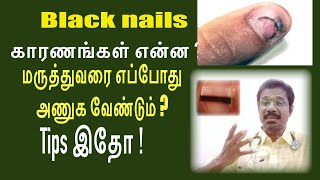 நகத்தில் கருப்பு கோடு விழுவது எதனால் What is the solution black nails health tamil [upl. by Cammie125]