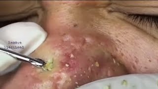 Acne Treatment Blackhead Removal on his nose Remove Blackhead removeblackhead [upl. by Graehl]