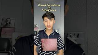 Closed Comedones Vs Fungal Acne acne [upl. by Wendeline]