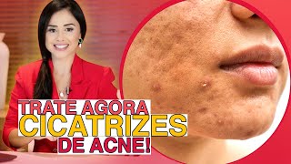 CICATRIZES DE ACNE TRATE SUAS CICATRIZES DE ACNE COM ESSAS 3 DICAS ALTAMENTE EFICIENTES [upl. by Aurora]