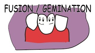 Fusion amp gemination part  2 [upl. by Hayton]