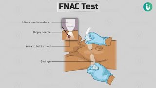 Fine Needle Aspiration Cytology  Procedures of FNAC test Technique [upl. by Yelyab]