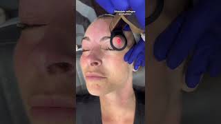 CO2 Laser Resurfacing Around The Eyes  Dr Medispa [upl. by Enirac]