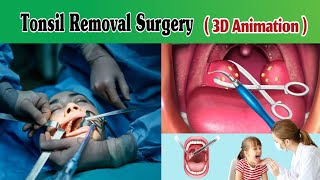 Tonsillectomy Surgery 3D Animation  Tonsillitis Surgery  Tonsils Operation [upl. by Lawson]