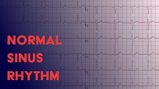 Normal Sinus Rhythm  EKG ECG Interpretation [upl. by Enia32]