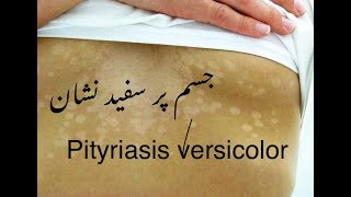 Pityriasis versicolor  جسم پر سفید نشان  funagal infection on skin DrHussainsharafat [upl. by Swetiana]