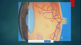 Cystoid Macular Oedema [upl. by Angelo664]