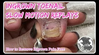 Pedicure Tutorial How to Remove Ingrown Toenail  Satisfying Slow Motion ⭐ [upl. by Estele]