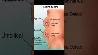 Ventral hernias motivation subscribe subscribe [upl. by Belford140]