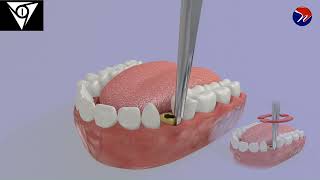 M1 Atraumatic ankylosed root extraction using pre elevator 1 [upl. by Sparky365]