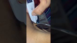 Warts remove in just 2 min  painless Treatment bamsdoctor skincare [upl. by Turk]