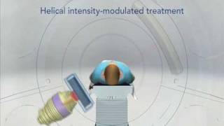 TomoTherapy  Revolutionary Radiation Therapy [upl. by Vaenfila]