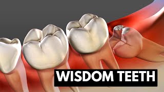 Wisdom teeth Causes Symptoms and Treatment [upl. by Owain]