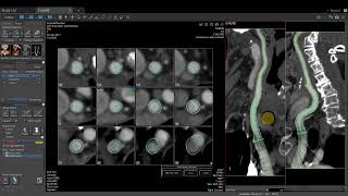 Vitrea Demonstrations  Carotid CTA [upl. by Refinneg]