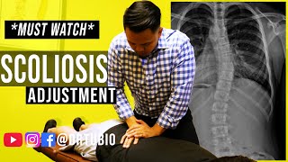 SEVERE SCOLIOSIS pain RELIEVED after Chiropractic Adjustments  Dr Alex Tubio [upl. by Oinotnaesoj]