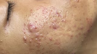 ACNE TREATMENT VU QUYNH MI  Perennial Blackheads On Boy Face 2024FULL [upl. by Macegan500]