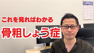 骨粗しょう症〜これを見ればわかる。検査から治療方法まで説明〜 [upl. by Chainey]