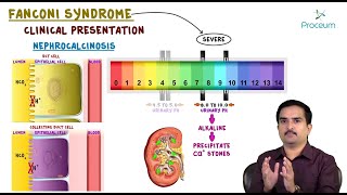 Fanconi syndrome  Etiology Clinical Features Pathology Diagnosis and Treatment usmle pathology [upl. by Ibib80]