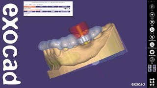 exocad Quick Guide Get most out of guided surgery [upl. by Yelsa]