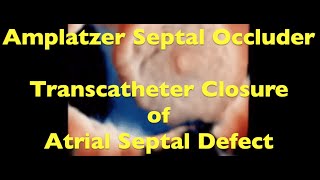 Amplatzer Septal Occluder Large Atrial Septal Defect [upl. by Tdnerb]