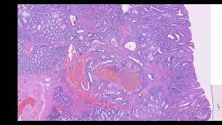 Colon adenoma with misplaced epithelium  case 3 [upl. by Nacim17]