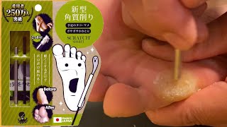 スクラッチスマートを使ってみました Callus care tool made in Japan [upl. by Lilly]