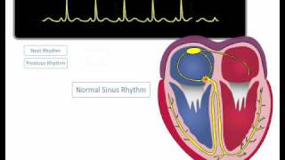 ECG Rhythm Review Sinus Rhythm Sinus Bradycardia Sinus Tachycardia [upl. by Leinahtan670]