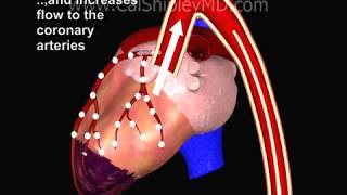 Cardiogenic Shock and Intraaortic Balloon Pump by Dr Cal Shipley MD [upl. by Arihday630]